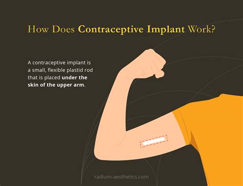 Contraceptive Implant Working