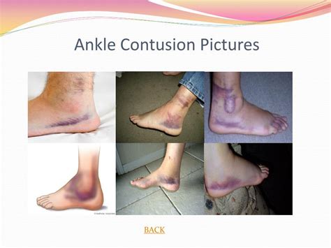 contusion causes