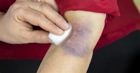 contusion causes