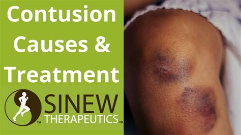 contusion conclusion