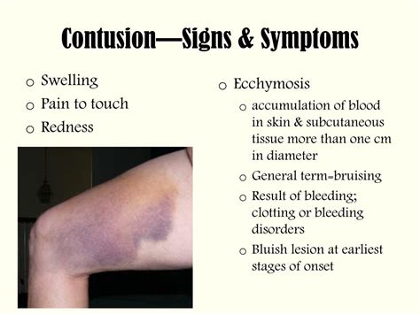 contusion symptoms