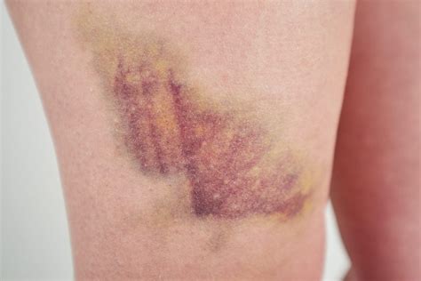 contusion treatment