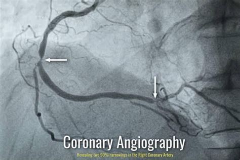 coronary angiogram procedure