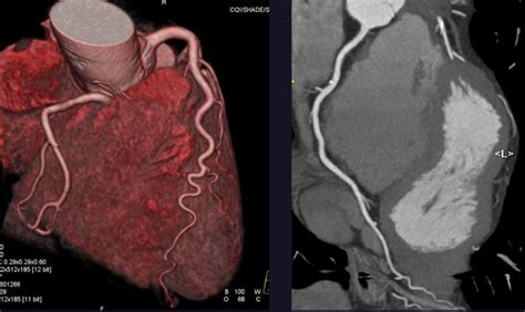Coronary CT Scan