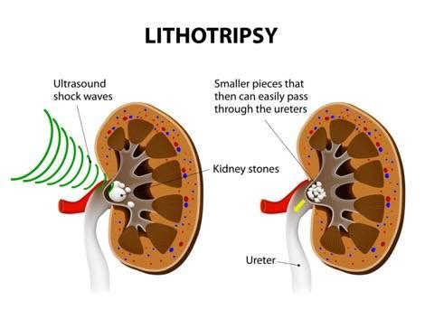 lithotripsy cost