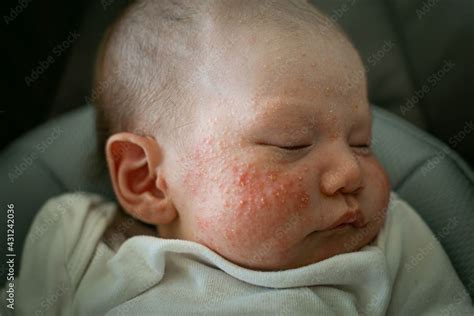 Cradle Cap and Eczema
