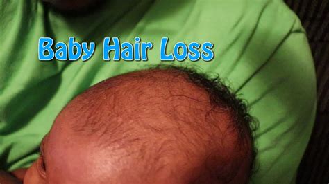 Cradle Cap and Hair Loss