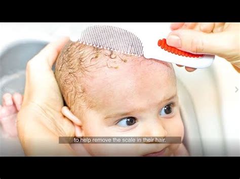 Cradle Cap Skin Care
