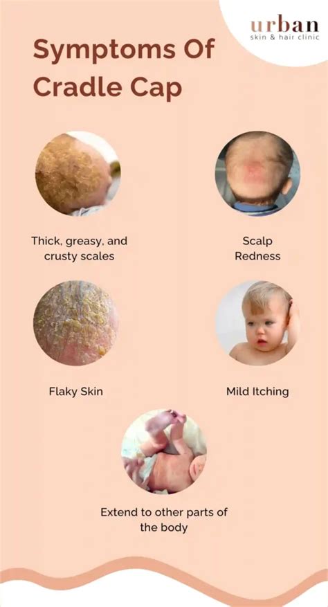 Cradle Cap Symptoms