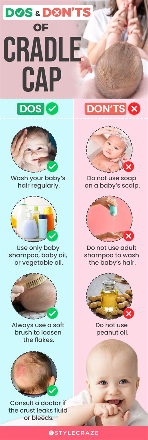 Cradle Cap Treatment Options