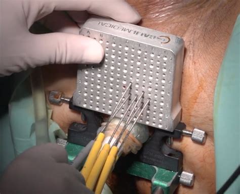 Cryotherapy for Moles
