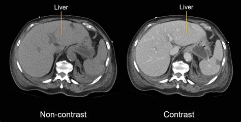 CT Abdomen Scan