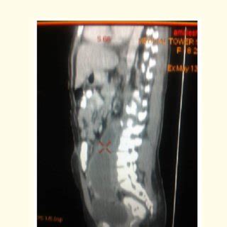 CT Abdomen Conclusion