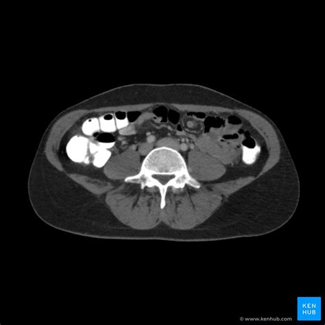 CT Abdomen Optimization