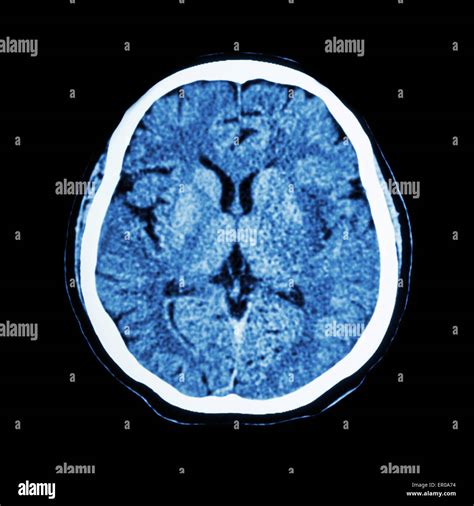 CT brain scan image