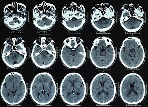 CT brain scan technology