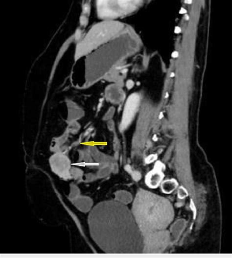 CT Scan Angiogram