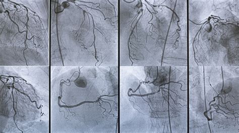 CT Scan Angiogram for Different Parts