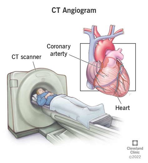 CT Scan Angiogram Risks