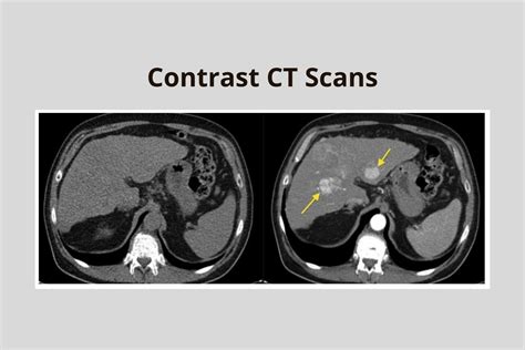 CT Scan Contrast Agents
