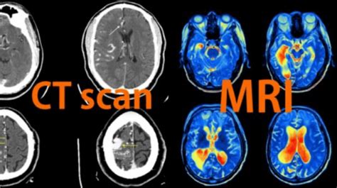 CT Scan Results