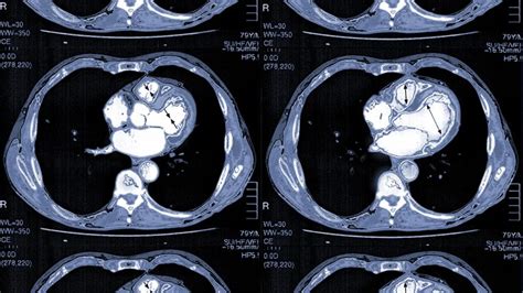 CT Scan Results