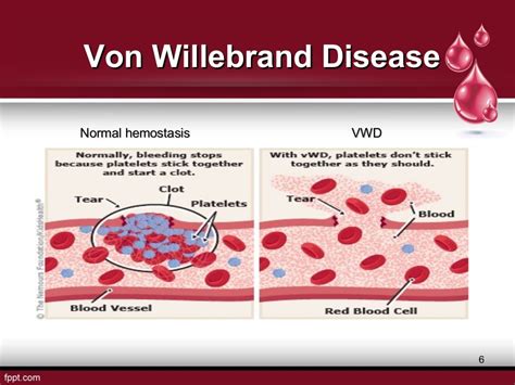Current research and future directions for von Willebrand disease