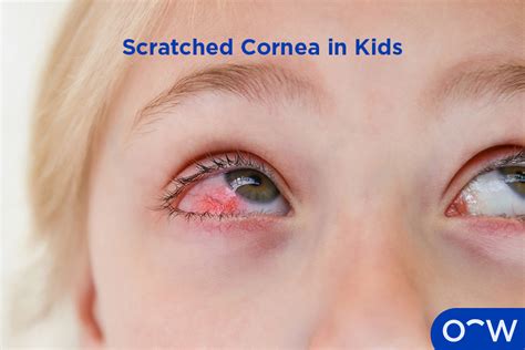 Cut on eyeball injury