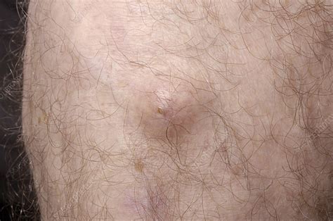 Cyst on leg removal options