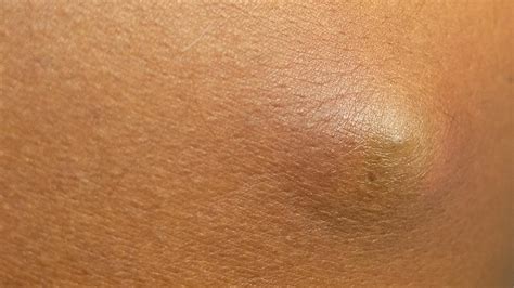 Cyst on leg removal cost