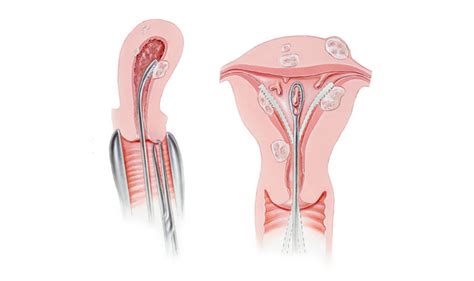 D&C procedure