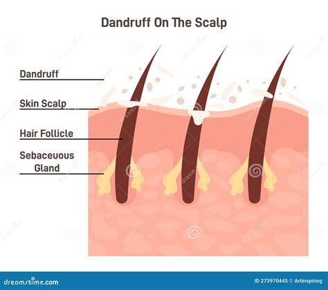 ketoconazole cream for dandruff