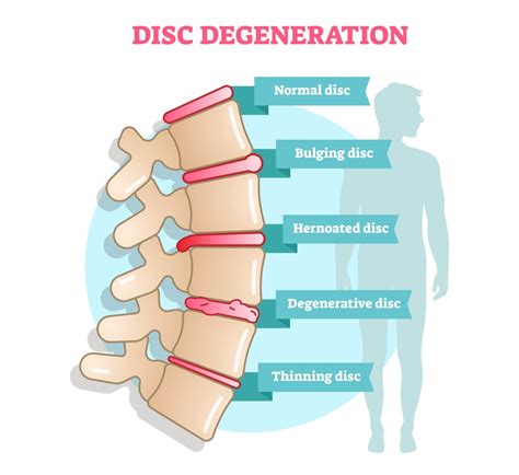 Degenerative Disk Disease