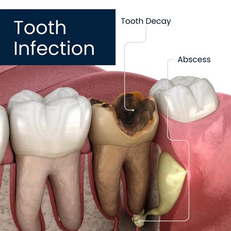 Metronidazole in Dental Infections