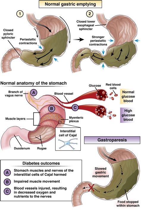 diabetes and stomach paralysis