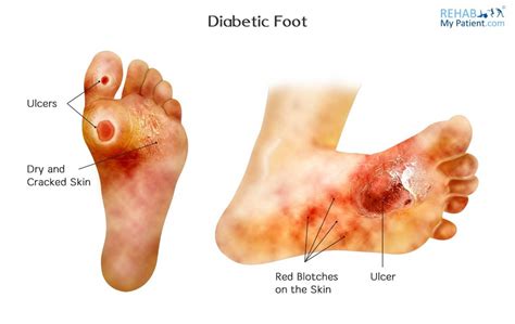Diabetic foot issues