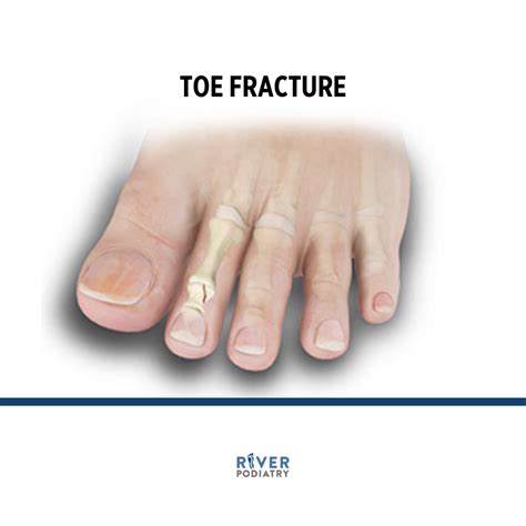 Diagnosing a Toe Break