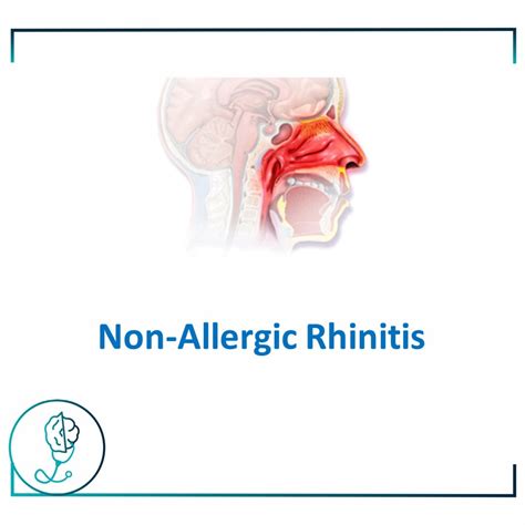 diagnosing non-allergic rhinitis