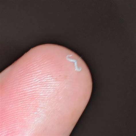 Diagnosing Pinworms