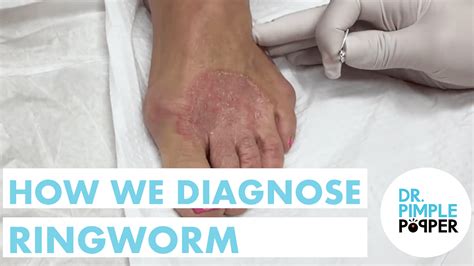 Diagnosing Ringworm