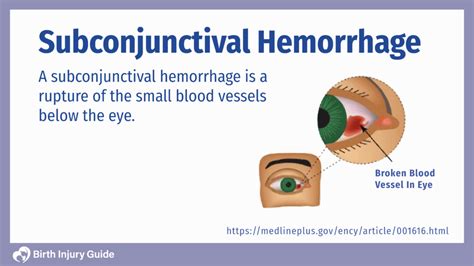 Diagnosis of Conjunctival Hemorrhage