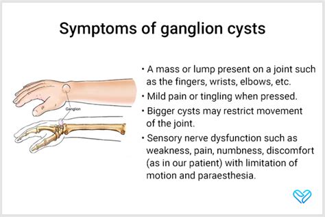 diagnosis of ganglion cysts