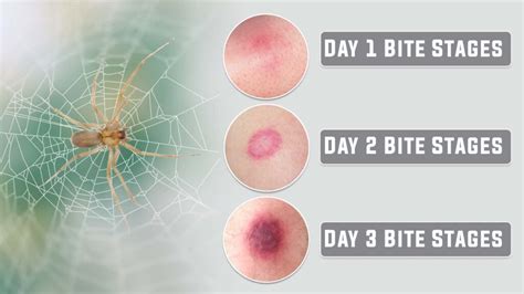 Diagnosis of Brown Recluse Spider Bites