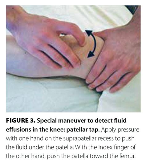 Diagnosis of knee effusion