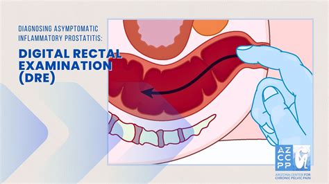 Digital Rectal Examination Procedure