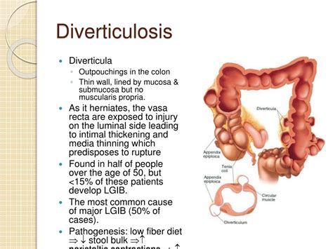Diverticulitis Causes
