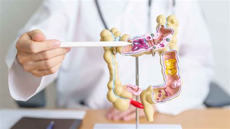 Diverticulitis Conclusion