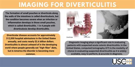 Diverticulitis Diagnosis