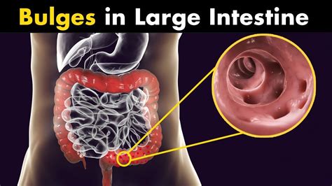 Diverticulitis Symptoms