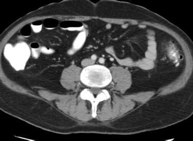diverticulosis detection